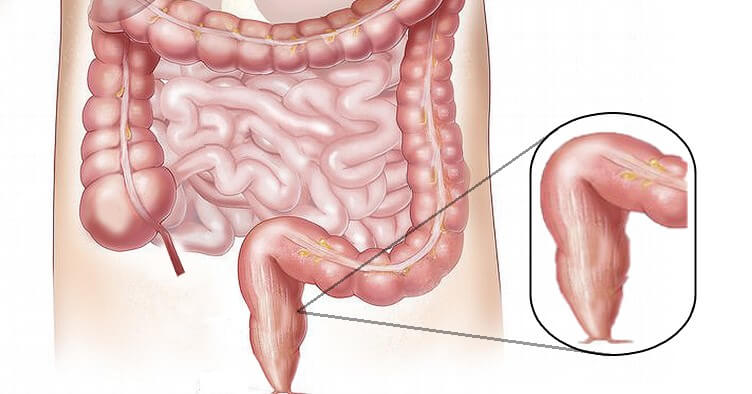 colon disease